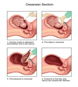 Steps of Cesarean Section