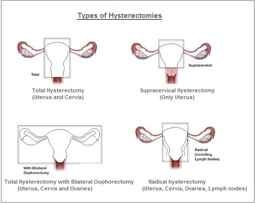 Types of Hysterectomy