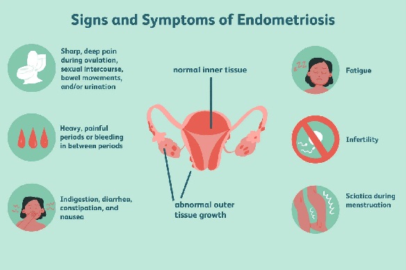 Endometriosis Symptoms