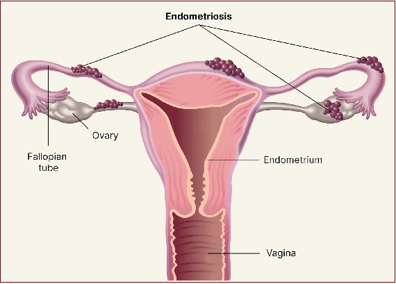 Endometriosis Sites