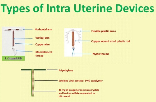 Intra-Uterine Devices