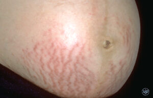 Stretch marks (Striae Gravidarum)