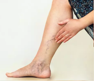 Varicose veins in Pregnancy