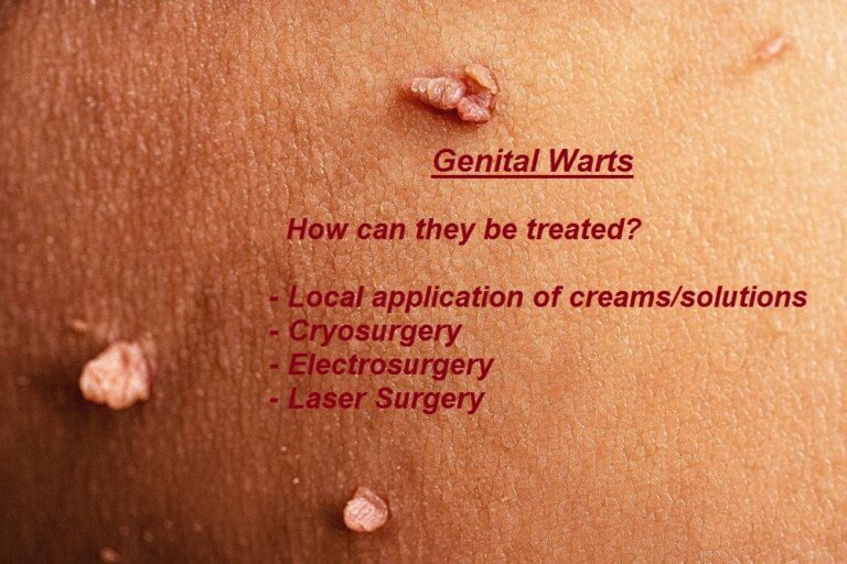 Genital Warts